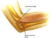 What is Arthroscopic Tennis Elbow Surgery?